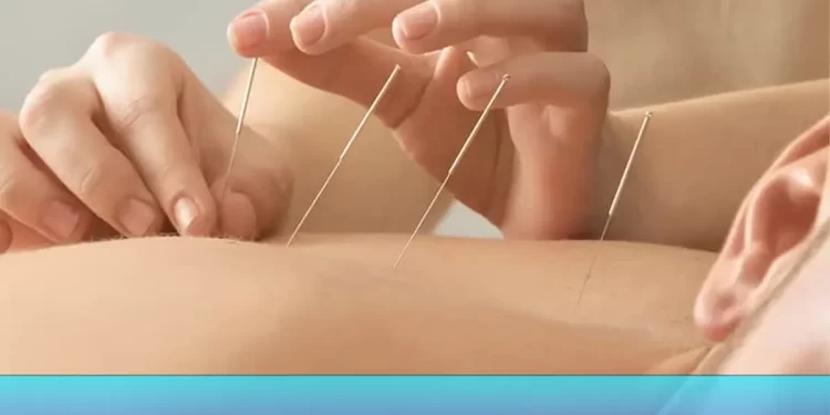 طب سوزنی در کاهش وزن موثر است